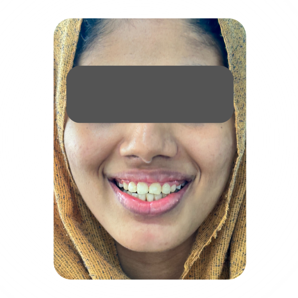 Gummy Smile correction