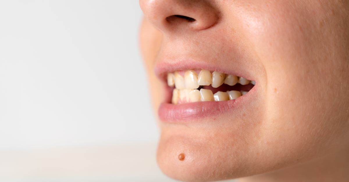 Understanding Class 3 Malocclusion: Causes, Symptoms, and Treatment Options