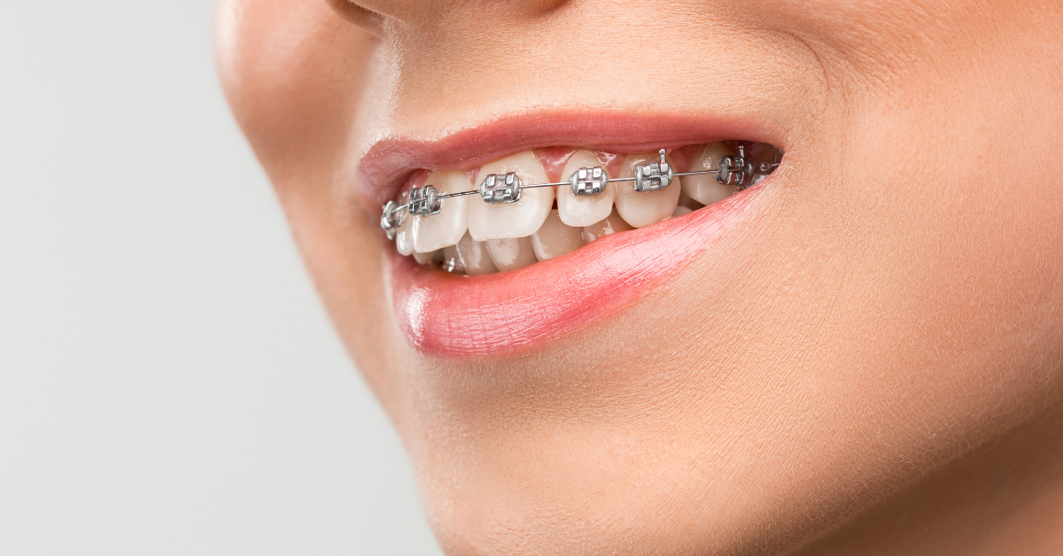 Why Teeth Can Shift Back After Braces: Understanding Orthodontic Retreatment