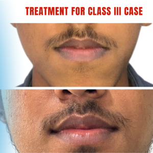 Can You Fix a Class 3 Malocclusion Without Surgery? Non-Surgical Approaches Explained