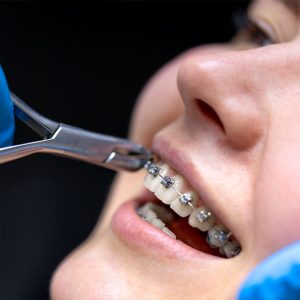 Orthodontic Retreatment with Micro-Implants: A Modern Solution for Relapsed Teeth