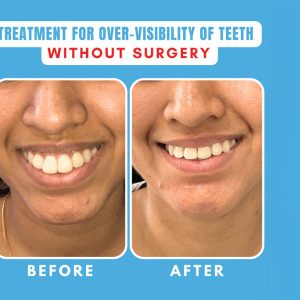 Correcting Over Visible Teeth in Adults: It’s Never Too Late