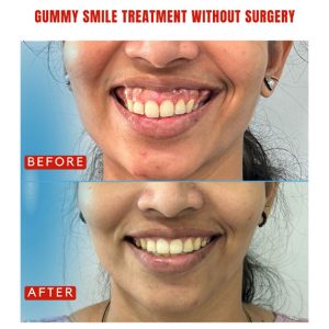 Why Are More People Choosing Non-Surgical Gummy Smile Treatments?