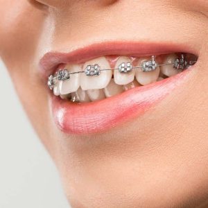 Why Teeth Can Shift Back After Braces: Understanding Orthodontic Retreatment