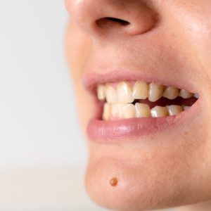 Understanding Class 3 Malocclusion: Causes, Symptoms, and Treatment Options
